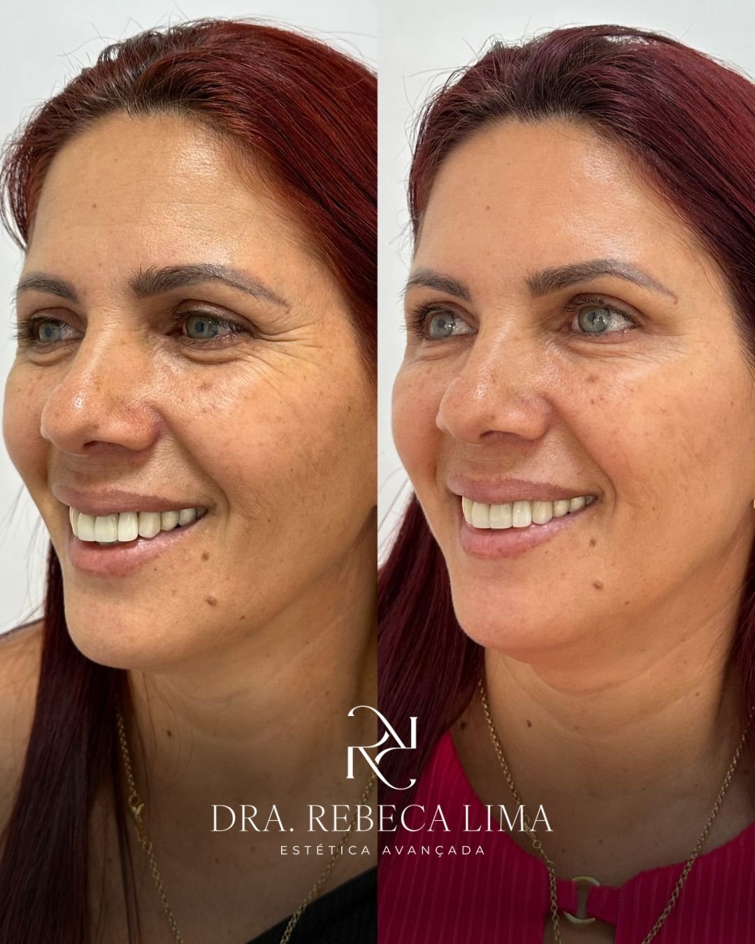 Antes e depois — harmonização facial