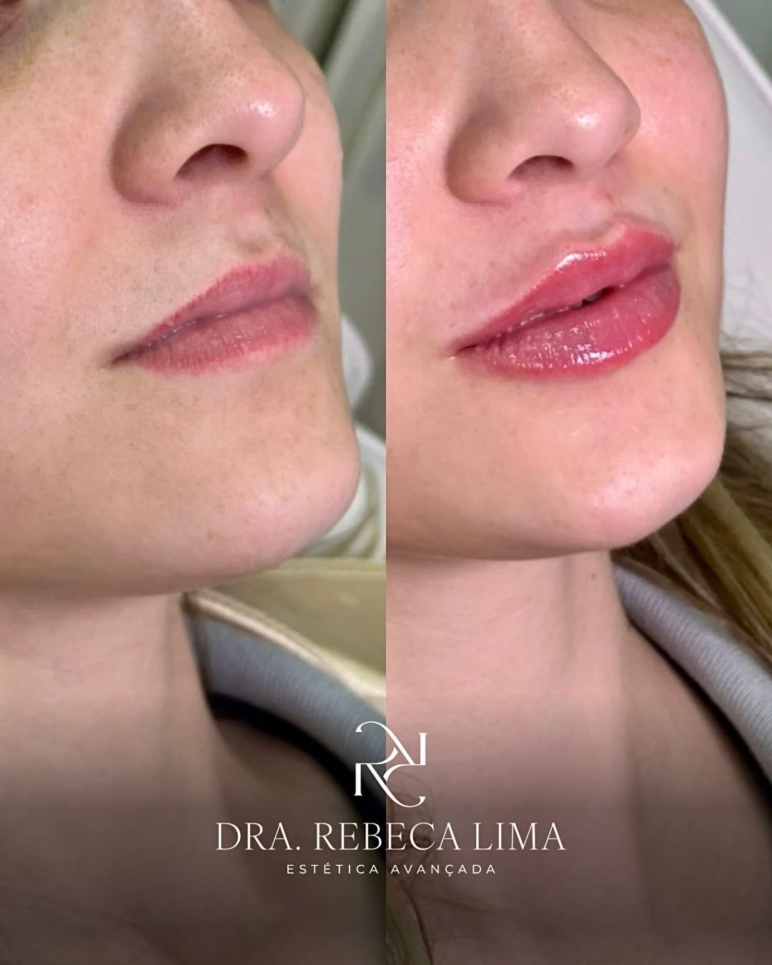 Antes e depois — preenchimento labial
