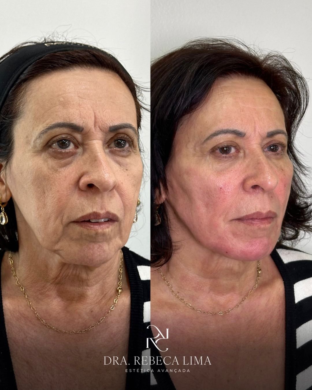 Antes e depois — rejuvenescimento