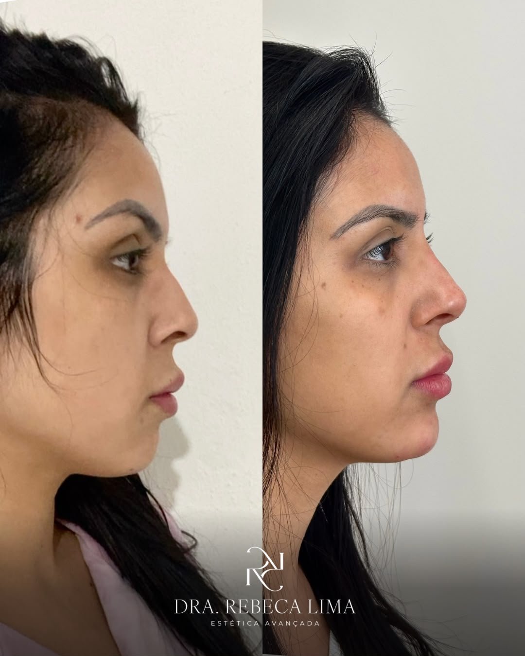 Antes e depois — rinomodelação e lábios
