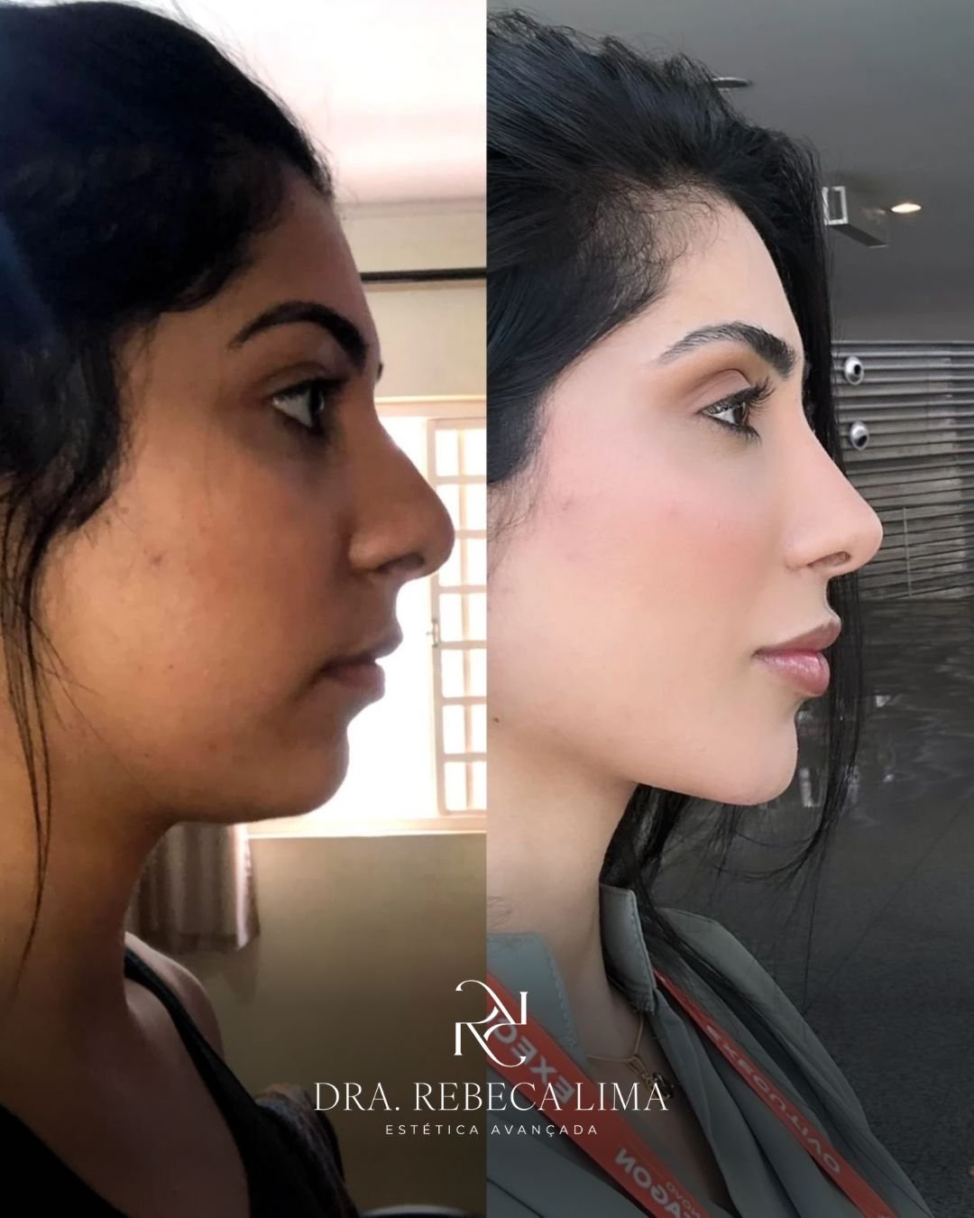 Antes e depois — harmonização do perfil