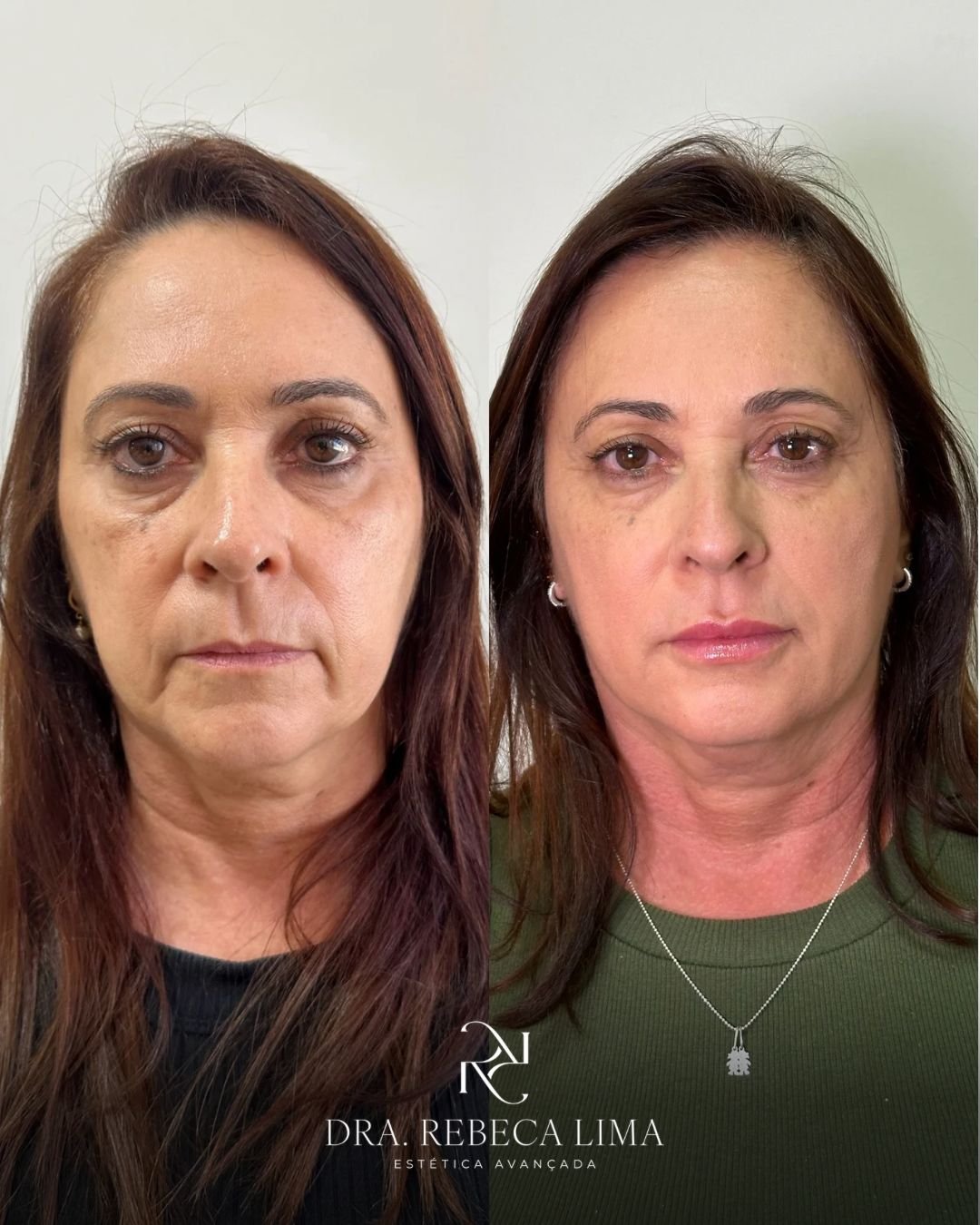 Antes e depois — rejuvenescimento facial